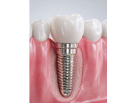 種植牙維護(hù)不用難(種植牙維護(hù)常識(shí))